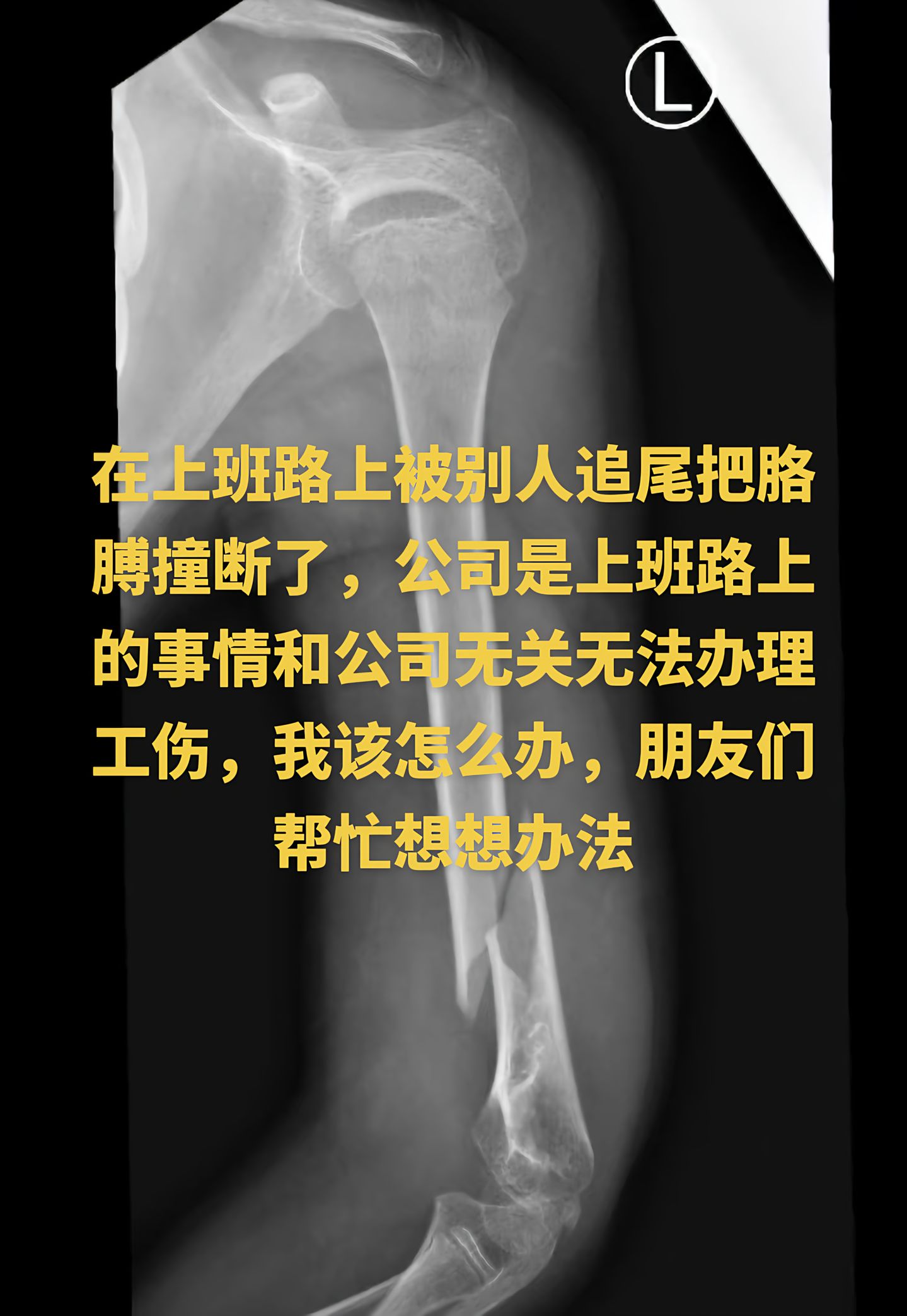 “在上班路上被别人追尾把胳膊撞断了，公司说上班路上的事情和公司无关无法办理工伤，我该怎么办，朋友们帮忙想想办法。”

3月13日，抖音博主“工伤小丁”发布了视频，用一张骨折X光片配上自己的疑问：上班途