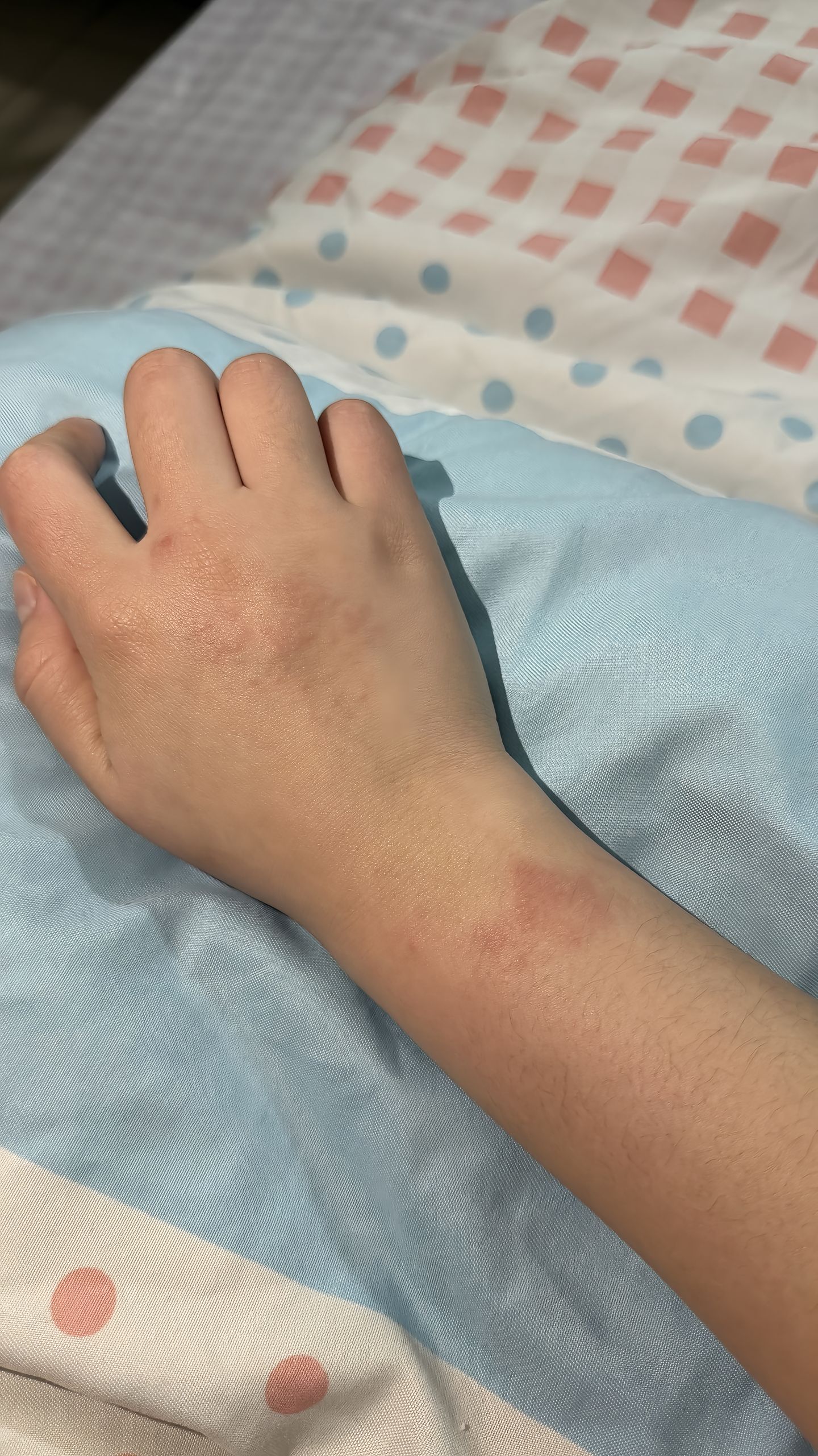 “入职瑞一年半了 换来了一双皮肤敏感 皮肤屏障受损 动不动起红疹子的手。”

1月28日，抖音博主王漏风发布了这则视频，画面中是一只躺在蓝色和粉色点点被褥上的手。手上的红疹、过敏反应和抓痕裸露地显示出