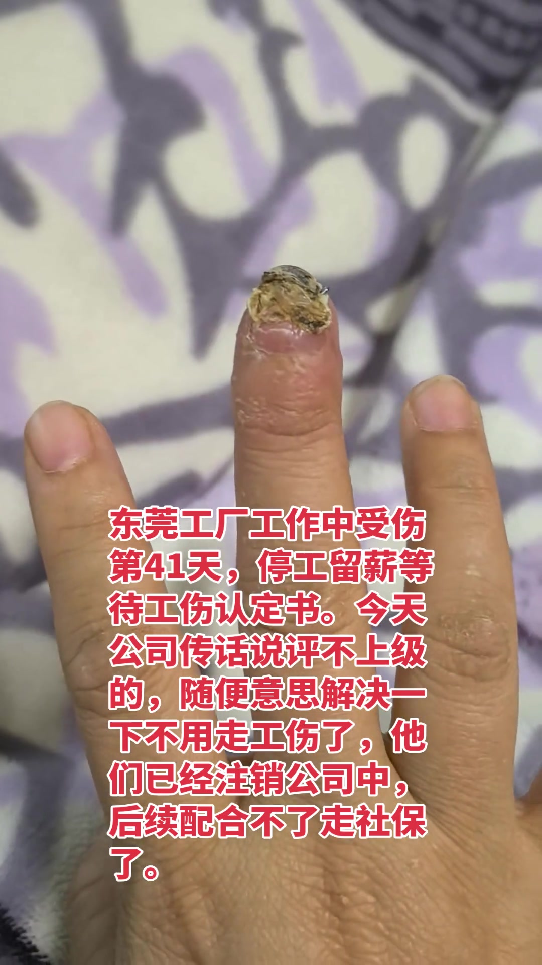 “右手指一个指甲盖骨头碎了。”

抖音博主“灵灵玖—玖妹”连续记录了自己在东莞工厂工作中受伤后的全过程。11月21日，她在操作机器时右手中指被压，诊断为末节开放性骨折，甲床挫裂，骨头粉碎并植入钢钉。随